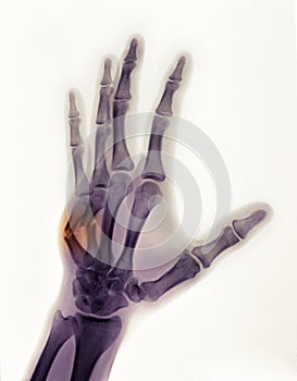 Hand x-ray showing a boxer's fracture