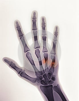 Hand x-ray showing a boxer's fracture