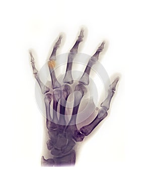 Hand x-ray showing a fracture