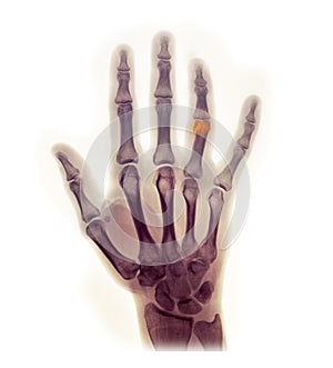 Hand x-ray showing a fracture