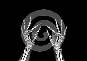 Hand x-ray and test finger to finger