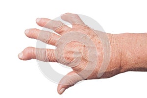 Hand With Rheumatoid Arthritis