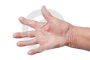 Hand With Rheumatoid Arthritis