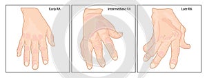Hand with rheumatoid arthritis