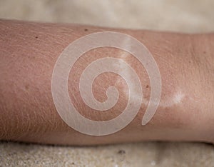 The hand with the scar