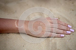 The hand with the scar