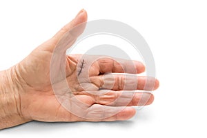 Hand surgery of a Dupuytren`s disease, contracture or a trigger