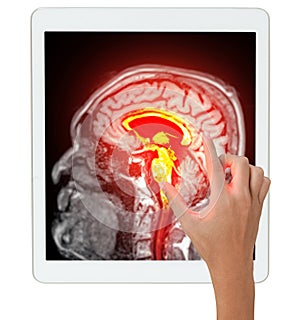A hand touches a tablet screen displaying a brightly highlighted MRI brain scan, focusing on the central brain structures in red photo