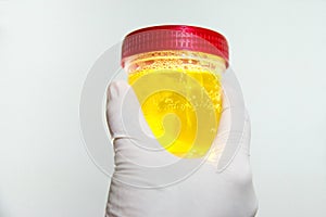 Hand with urine container