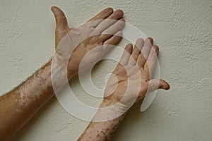 Hand with vitiligo conditions