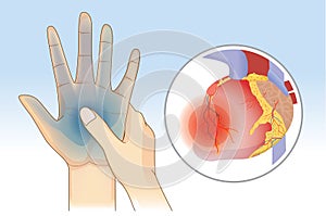 Hand weakness symptom can be caused by heart disease.