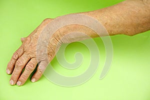 Hand Of Woman Deformed From Rheumatoid Arthritis