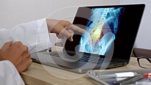 Hand of a woman doctor showing a x-ray of pain in the spine on a laptop. Right to left Close up shot
