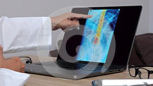 Hand of a woman doctor showing a x-ray of a spine on a laptop. Close up shot