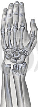 Hand and Wrist - Broken Radius Bone photo