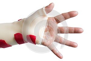 Hand with wrist and thumb splint