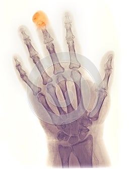 Hand X-ray, fractured/amputated distal phalanx photo