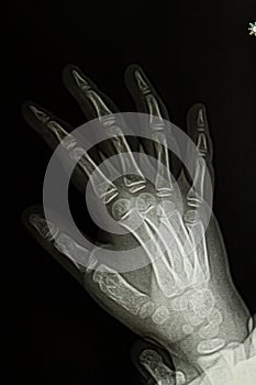 hand x-ray image