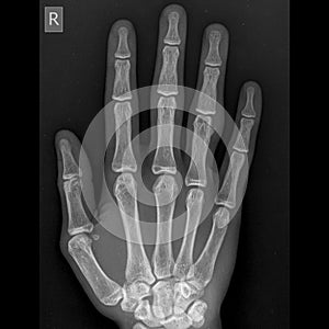 Hand x-ray image ap view