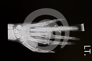 Hand x-rays image