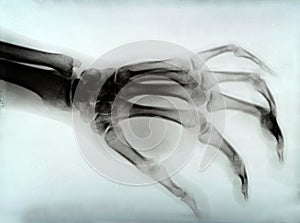 Hand xray