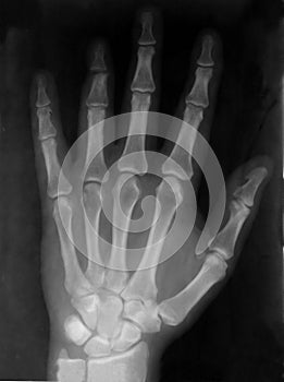 Hand xray photo