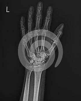 Hand xray film