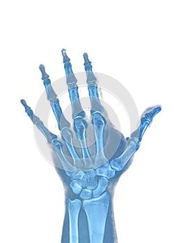 Hand xray