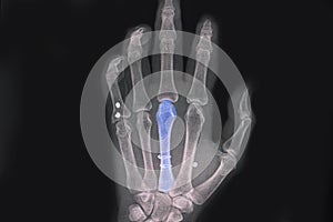 Hand xray showing spiral fractured third metacarpal bone