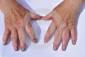Hands affected by arthrosis disease