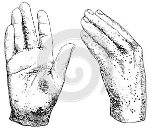 Hands afflicted with scabies.