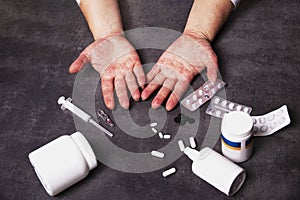 Hands with allergies and medicines for illness