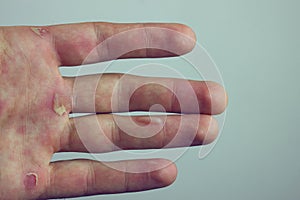 Hands with blister and callus