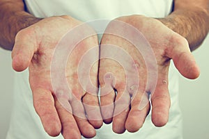 Hands with blister and callus