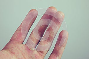 Hands with blister and callus