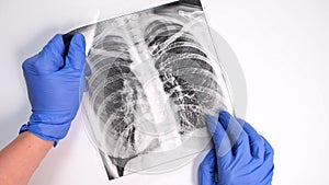 Hands of a doctor in blue gloves examining, checking fluorography, x-ray of a patient during epidemia, pneumonia and