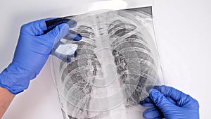 Hands of a doctor in blue gloves examining, checking fluorography, x-ray of a patient during epidemia, pneumonia and bronchitis