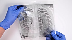 Hands of a doctor in blue gloves examining, checking fluorography, x-ray of a patient during epidemia, pneumonia and bronchitis tr