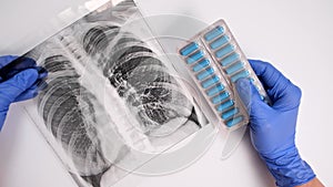 Hands of a doctor in blue gloves showing antibiotics, pills against infection, fluorography, x-ray on bakground