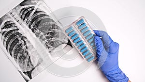 Hands of a doctor in blue gloves showing antibiotics, pills against infection, fluorography, x-ray on bakground, pneumonia and