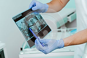 Hands doctor dentist in gloves show the teeth on x-ray foto in dental clinic on light background with medical equipment. Smile