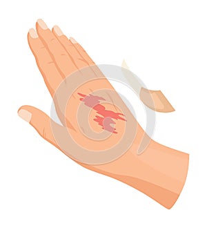 Hands injured skin and procedures of bandaging. First aid for wound. Medicine cure or treatment. First emergency help