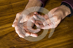 The hands of a male with Psoriatic Arthritis