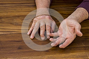 The hands of a male with Psoriatic Arthritis