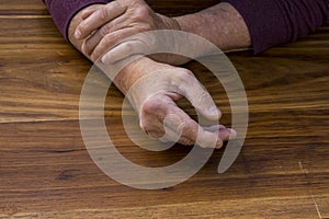 The hands of a male with Psoriatic Arthritis