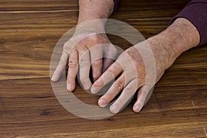 The hands of a male with Psoriatic Arthritis
