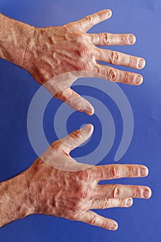 Hands of an man with Dupuytren contracture on blue