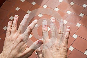 Hands of man with eczema