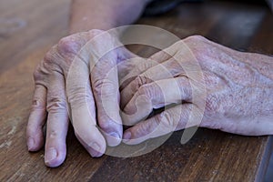 The hands of a man with psoriatic arthritis on a wooden table photo