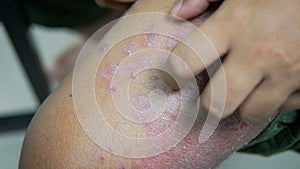 Hands of man scratching to leg skin rash